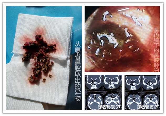 二十年鼻臭，一朝解除